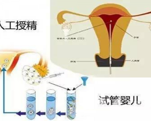 人工授精与试管婴儿的区别是什么？从费用、技术和成功率三方面分析