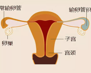 输卵管积水对试管婴儿移植有影响吗——提前治疗很重要