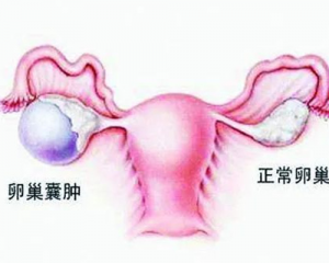 卵巢囊肿的形成原因和注意事项